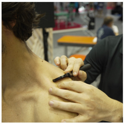 Why combine EKMAN myofascial hooks and Winback Technology?